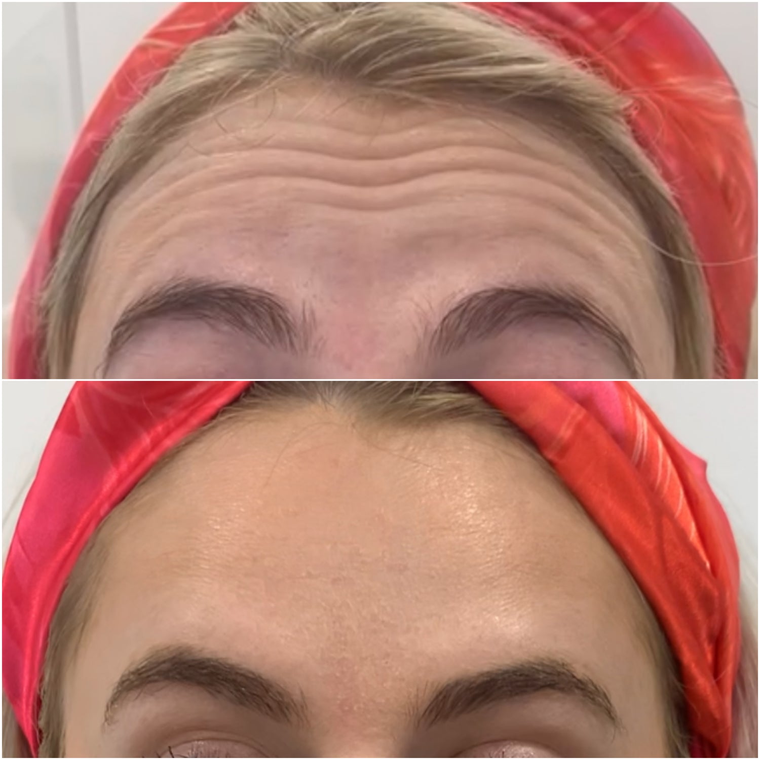 Before and after Botox treatment showing the reduction of wrinkles and smoother, youthful skin on a woman's forehead and around her eyes